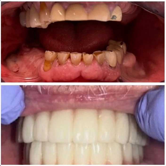 Dental Work Case 1 - Cosmetic Porcelain Veneers